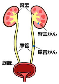 上部尿路がん | 奈良県立医科大学 泌尿器科学教室 ホームページ