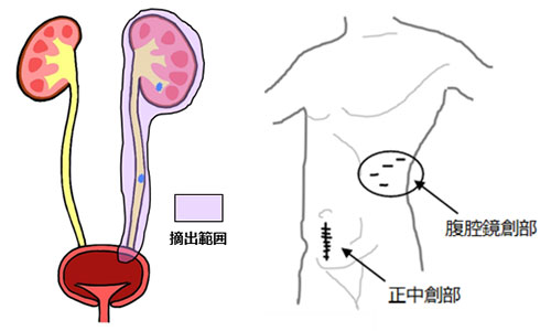 上部尿路がん | 奈良県立医科大学 泌尿器科学教室 ホームページ